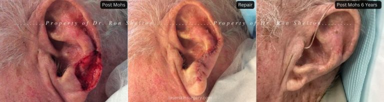 Post Mohs surgery on the ear, the repair and condition after 6 years