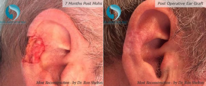 Post Operative Ear Graft and Post Mohs 7 months