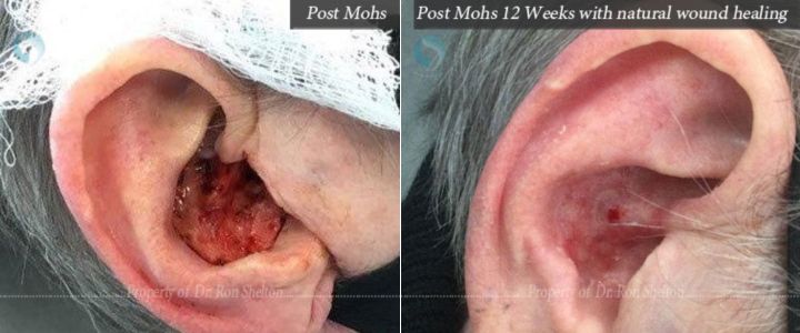 Post Mohs 12 weeks, No repair, healed with wound care no graft or flap