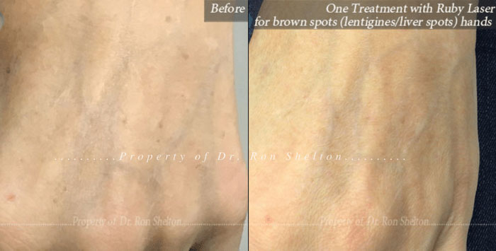 After One Treatment with Ruby Laser for brown spots (lentigines/liver spots) after 14 weeks
