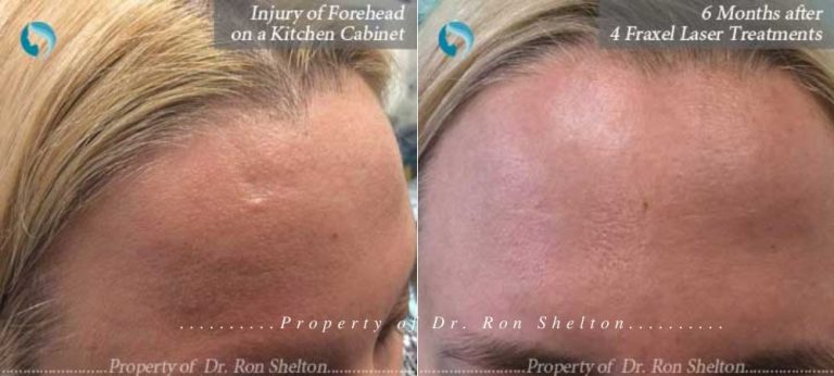 4 Fraxel Restore laser resurfacing treatments done after traumatically injuring her head on a kitchen cabinet. The post photo is six months after the fourth laser.