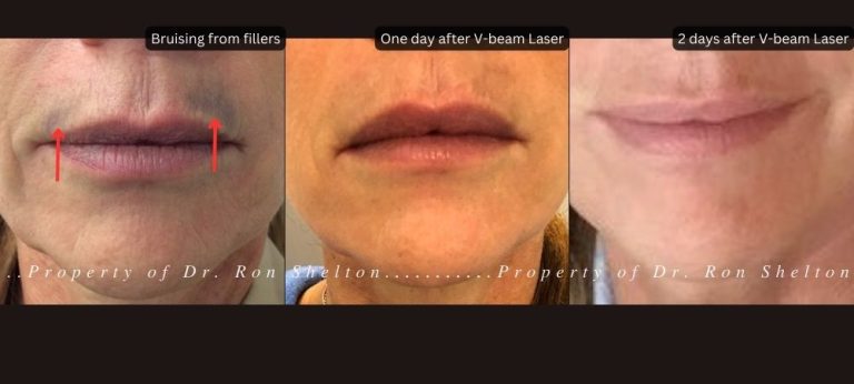 Bruising from fillers almost gone one day after V-beam Laser
