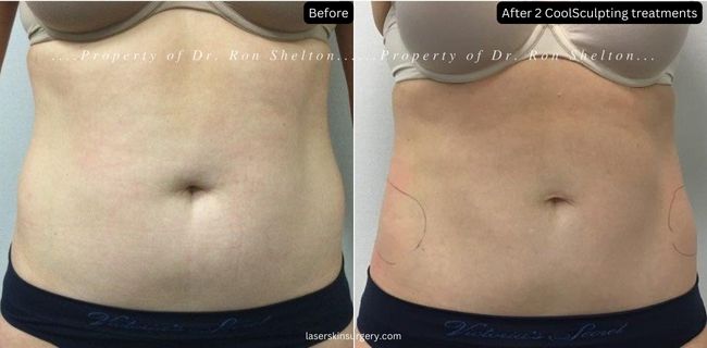 After 2 CoolSculpting Treatments for the Abdomen