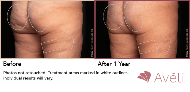treatment for cellulite in NYC