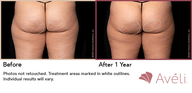 Aveli long-term treatment for cellulite in NYC