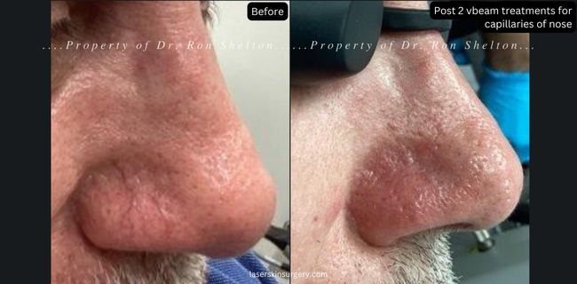 Post 2 Vbeam laser treatments for capillaries of nose