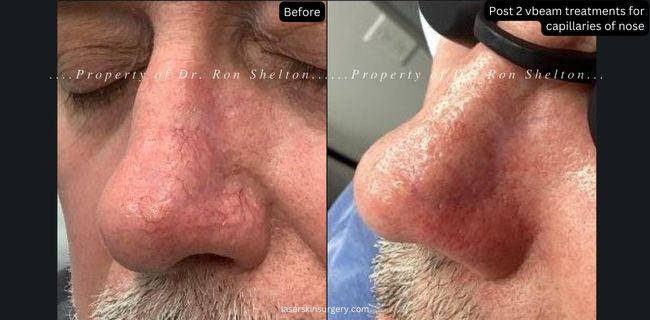 Post 2 Vbeam laser treatments for capillaries of nose