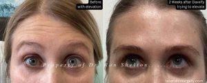 Dysport Botox Daxxify New York City before after | Ron Shelton MD