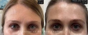 Dysport Botox Daxxify New York City before after | Ron Shelton MD