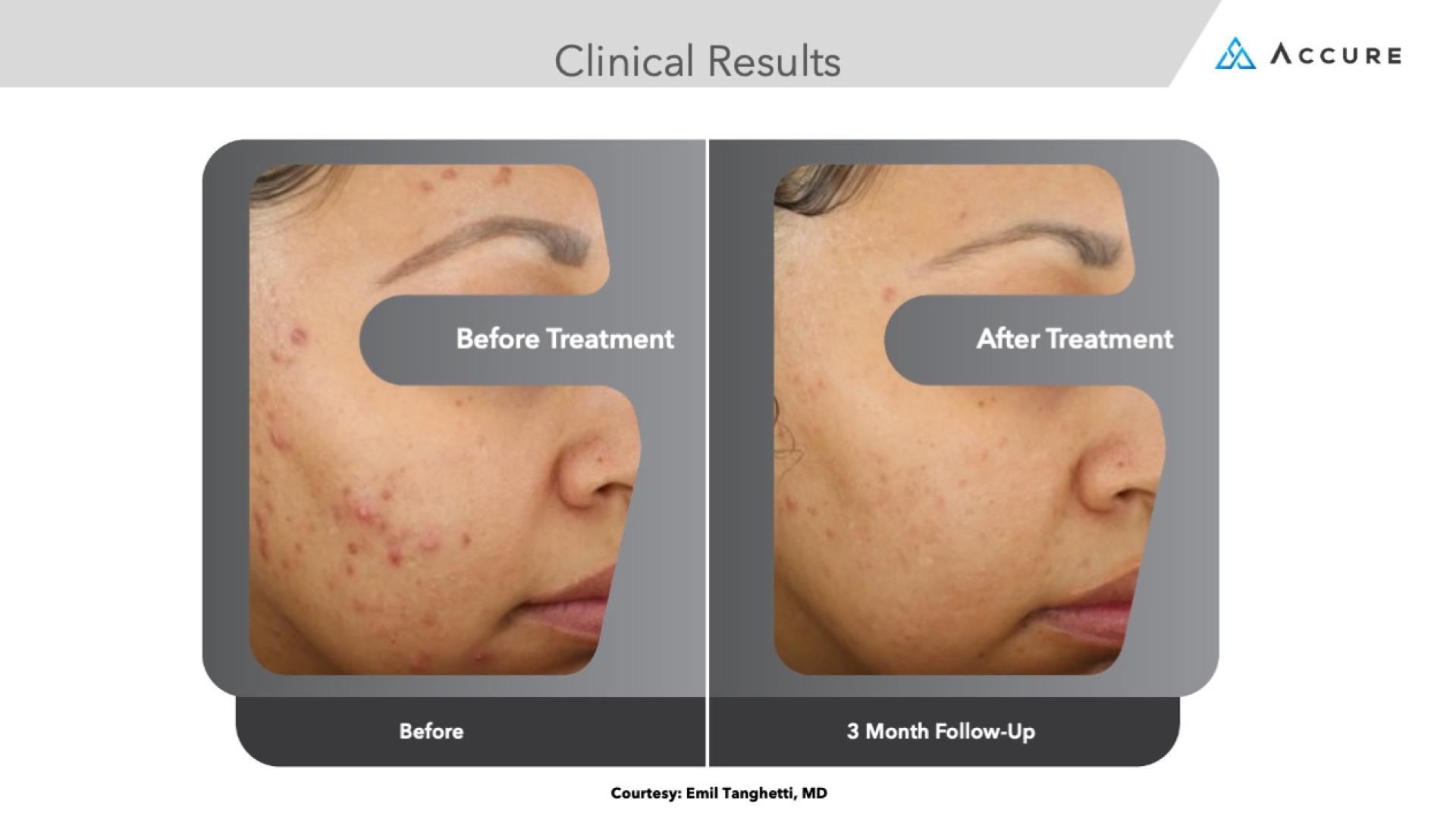 Accure laser for acne