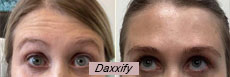 Daxxify before after photo gallery
