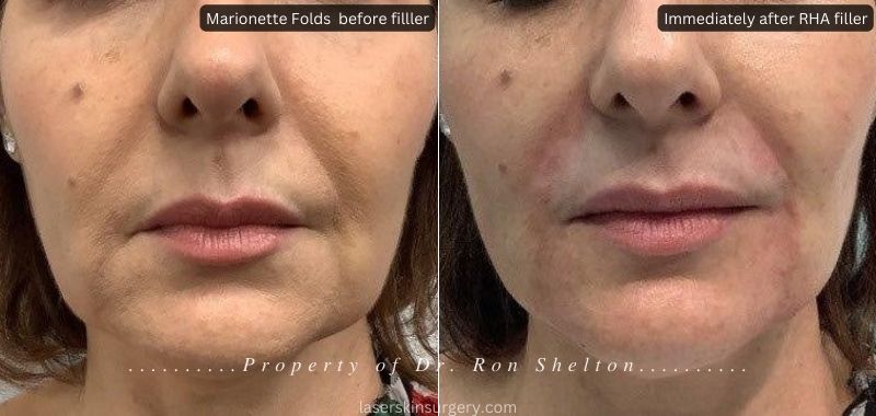 Before and after RHS fillers for smile lines