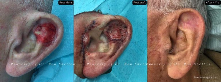 Post Mohs 4 yrs - Skin graft taken from in front of the left ear