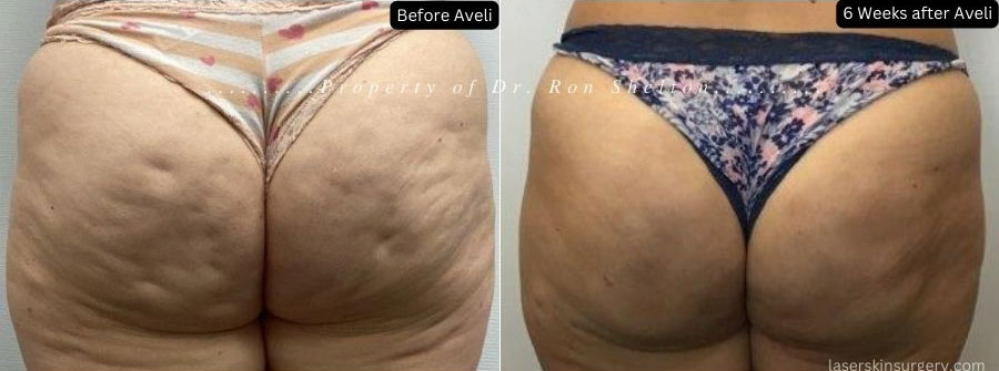 6 Weeks after Aveli for Cellulite Reduction