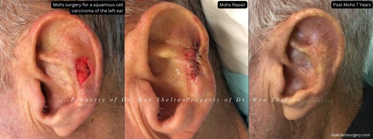 7 years after Mohs surgery for a squamous cell carcinoma of the left ear