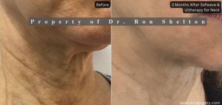 3 Months after Ultherapy & Sofwave for Neck