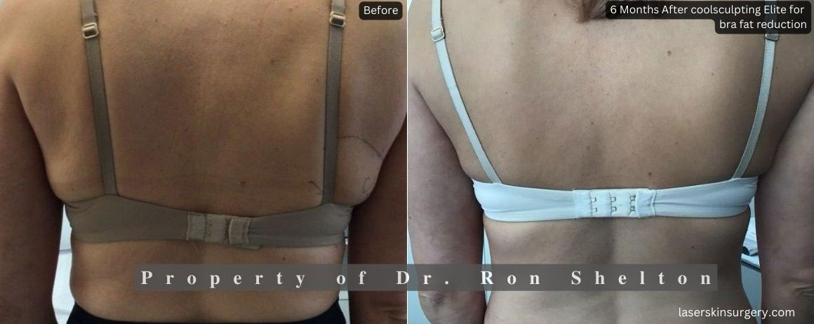 Before and After CoolSculpting procedure in NYC by Dr Ron Shelton