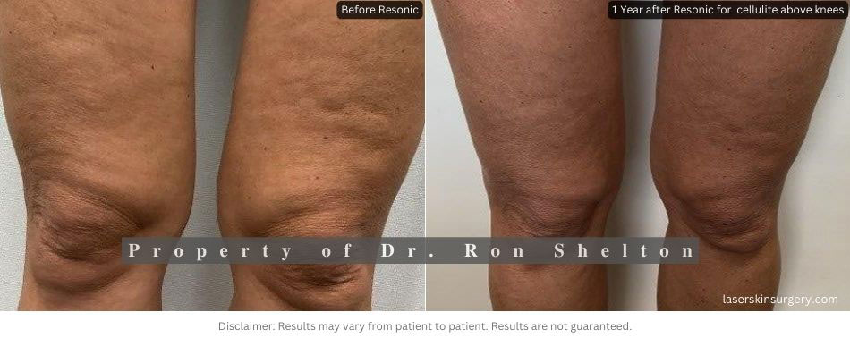 1 Year after Resonic for Cellulite above the knees