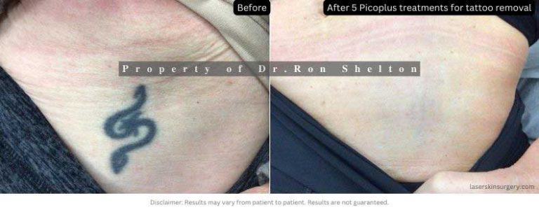 Tattoo removal after 5 pico plus treatments