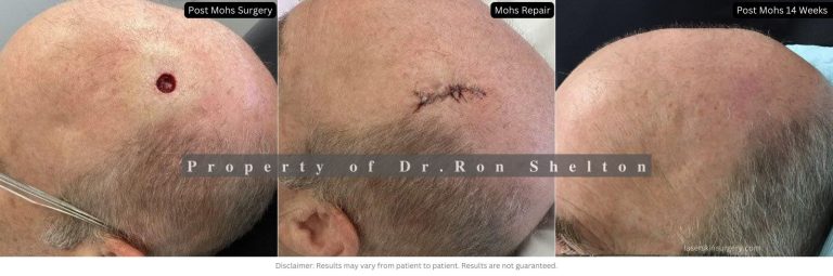 Mohs surgery on the scalp and results after 14 weeks