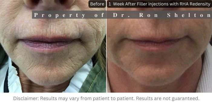 Filler injections with RHA Redensity softening wrinkles without plumping up lips in patient not able to have laser resurfacing