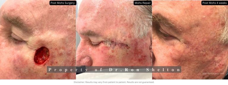 Mohs surgery on the temple, post Mohs 4 weeks