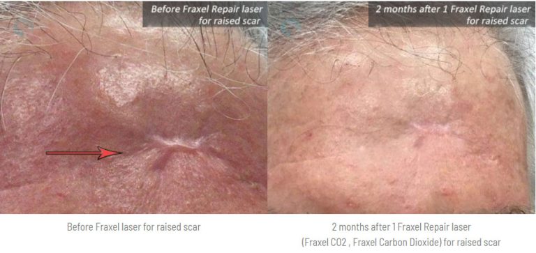 Fraxel laser for raised scar