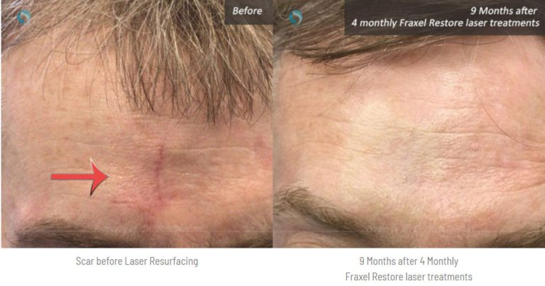 Laser resurfacing for scar