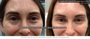 NYC Daxxify Before and After | Ron Shelton M.D. patient photos