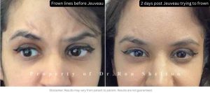 Dysport Botox Daxxify New York City before after | Ron Shelton MD