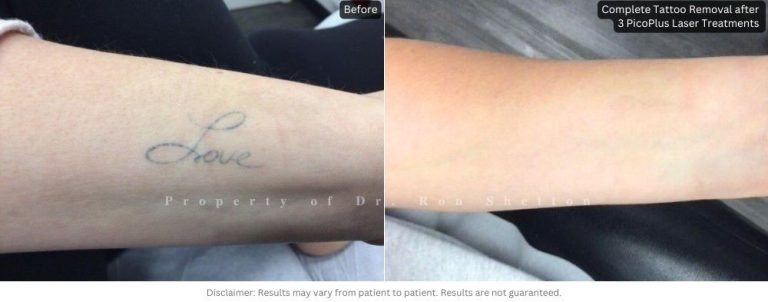 Complete tattoo removal after 3 picoplus treatments