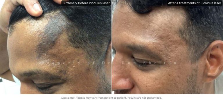Specific birthmark treated with 4 treatments of the PicoPlus laser. Test spots performed during two earlier visits confirmed that he was a good candidate and helped determine the optimal wavelength and energy settings for his birthmark.