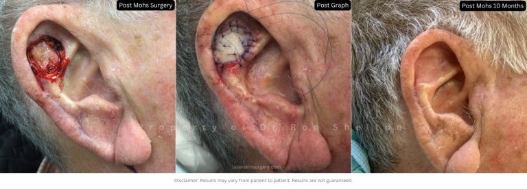 Post Mohs surgery, the graft and 10 Months After