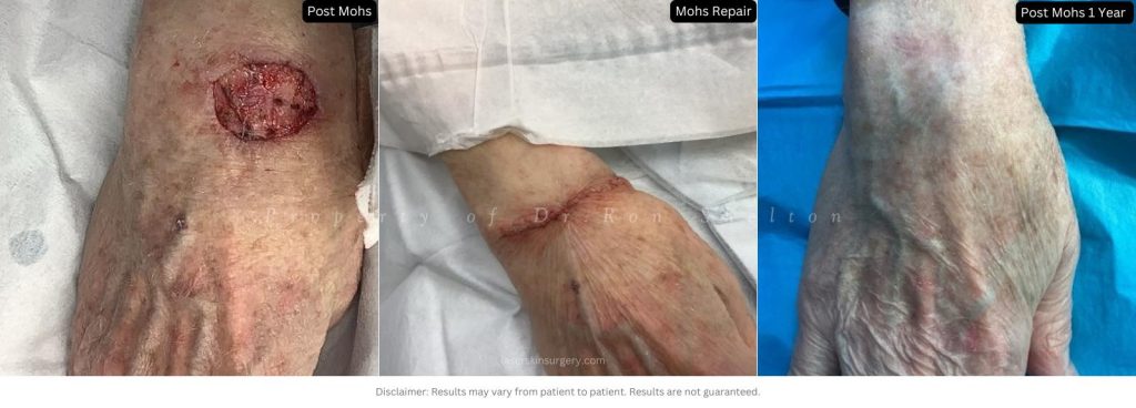 Post Mohs 1 Year on Hand