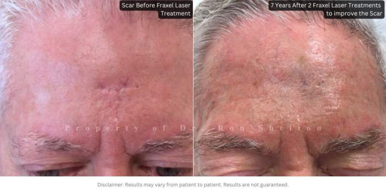 7 Years After 2 Fraxel laser treatments for scar revision