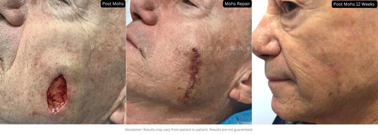 Post Mohs 12 weeks on the Cheek