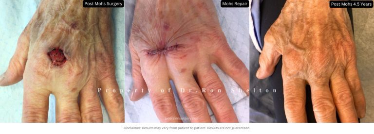 Post Mohs 4.5 Years on Hand