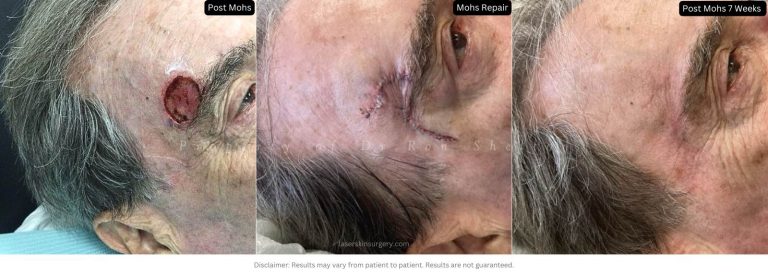 Post Mohs surgery 7 weeks on Forehead