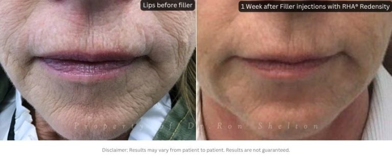 Filler injections with RHA® Redensity softening wrinkles without plumping up lips in patient not able to have laser resurfacing