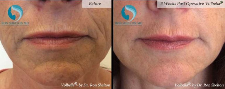 3 Weeks Post Operative Volbella®