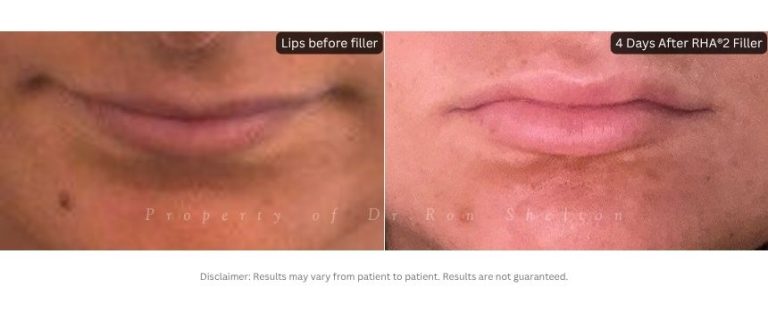 4 Days After RHA®2 Filler