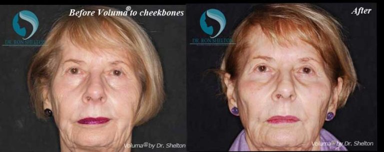 After Voluma® on Cheekbones