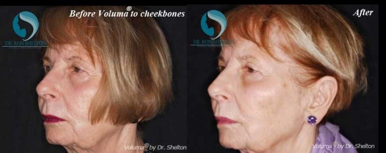 After Voluma® on Cheekbones