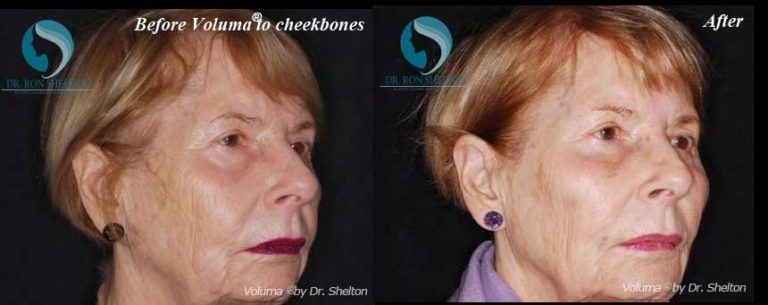 After Voluma® on Cheekbones