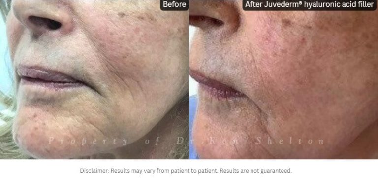 3 plus years after filler