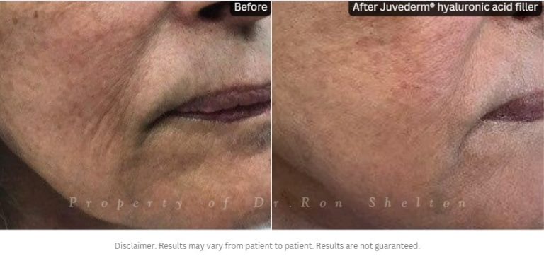 3 plus years after filler