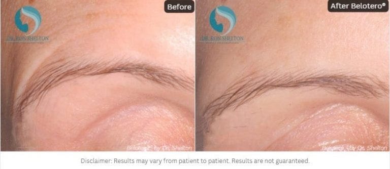 Belotero® on the forehead