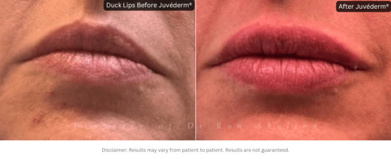 Duck lips treated with Juvéderm® Filler