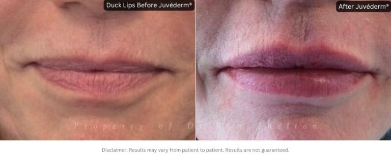 Duck lips treated with Juvéderm® Filler