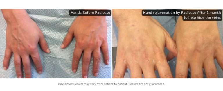 1 Month after Radiesse® Treatment Radiesse was injected to help hide the veins.